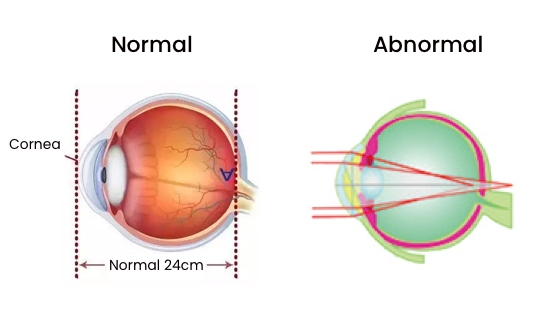 normal eye cyl vs abnormal eye cyl