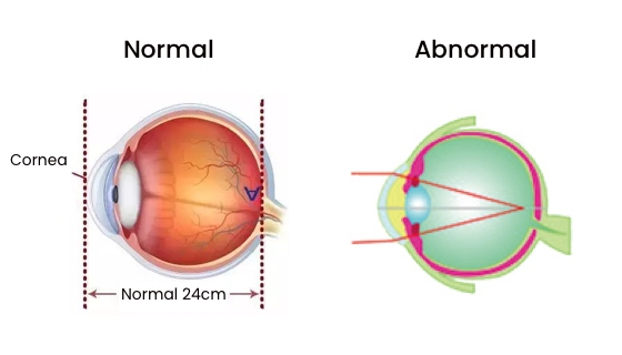 normal eye sph vs abnormal eye sph