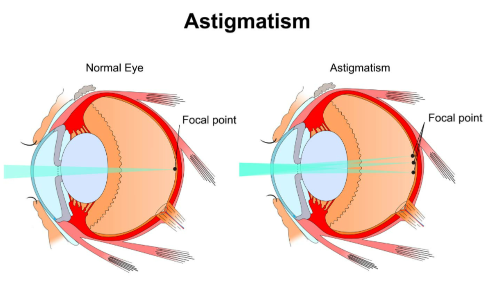 normal eye vs astigmatism