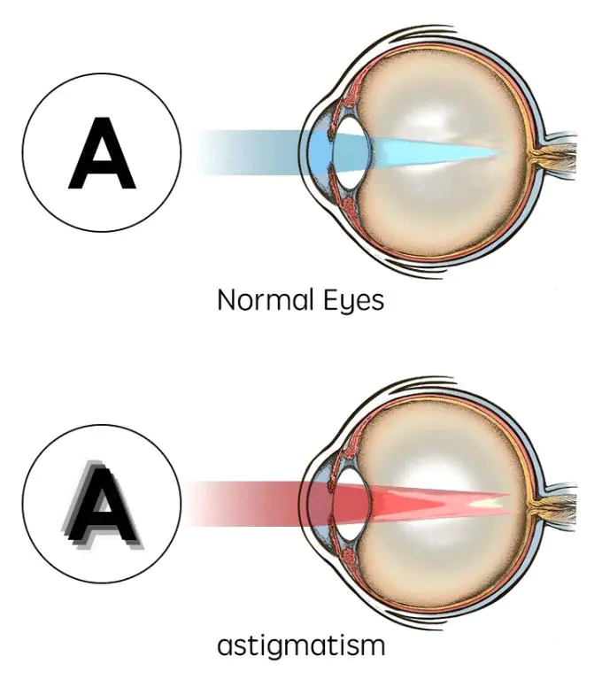 normal eyes vs astigmatism