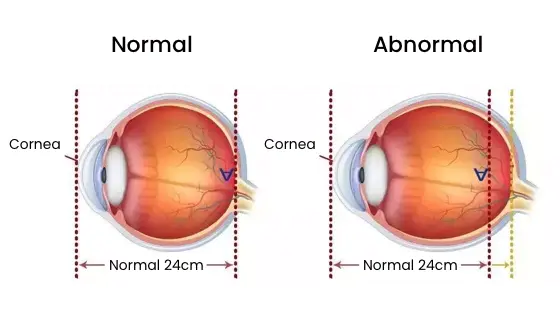 normal eye axis vs abnormal eye axis